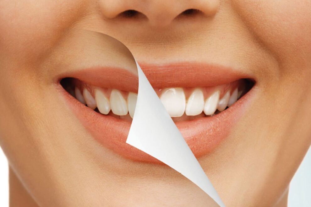 teeth-bleaching